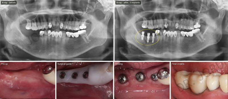 Why Does a Dental Implant Take 4 to 6 Months? A Step-by-Step Timeline