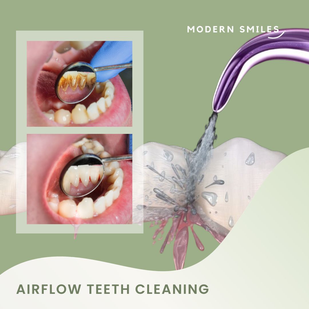 Airflow Teeth Cleaning Modern Smiles