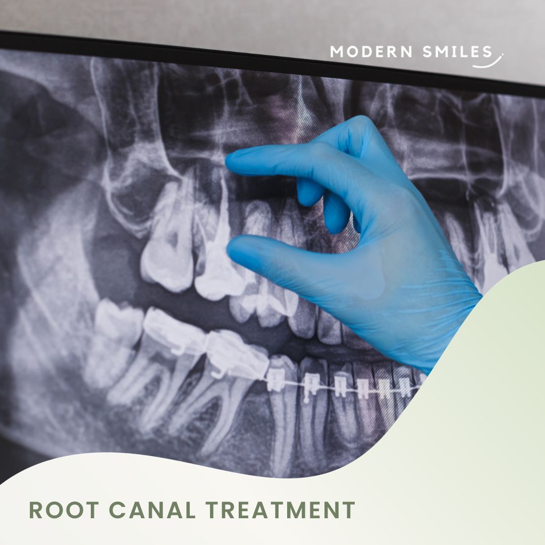 Root Canal