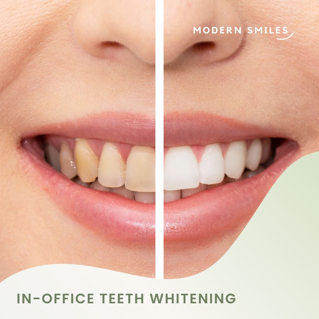 Teeth Whitening