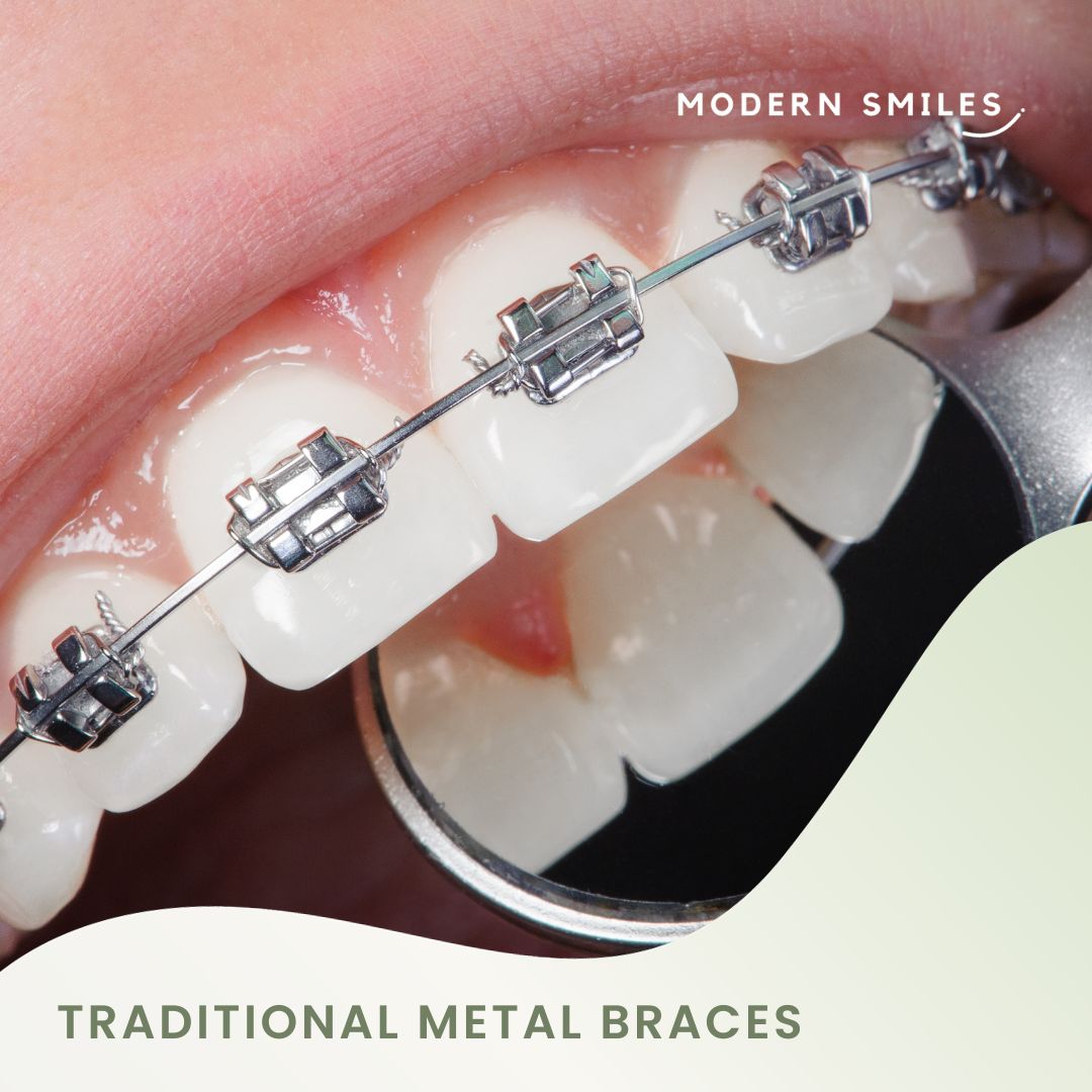 Traditional Metal Braces Cost In India