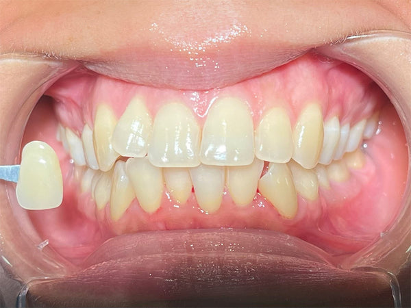 Before teeth whitening — Modern Smiles patient