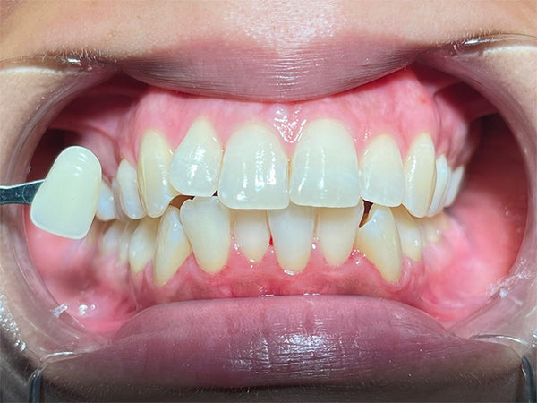 After teeth whitening — Modern Smiles patient