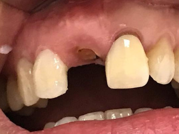 Before dental implant — Modern Smiles patient