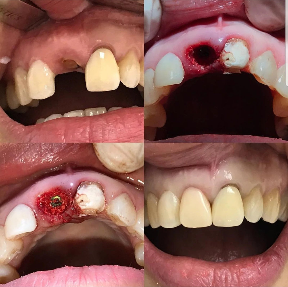 Immediate implant placement replacing an upper front tooth, from extraction to final crown