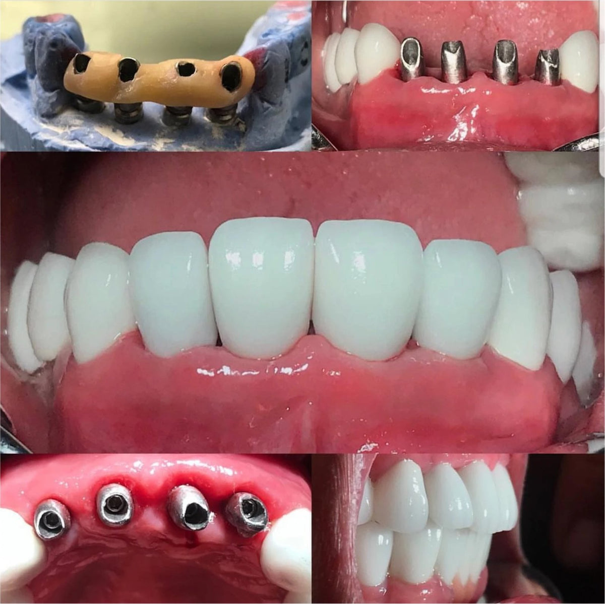 Four implants with custom abutments restored with zirconia crowns