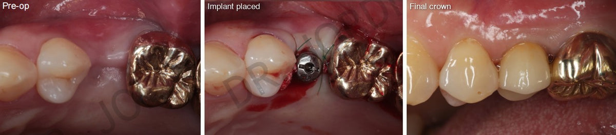 Single implant replacing an upper premolar: pre-op, implant placed, final crown