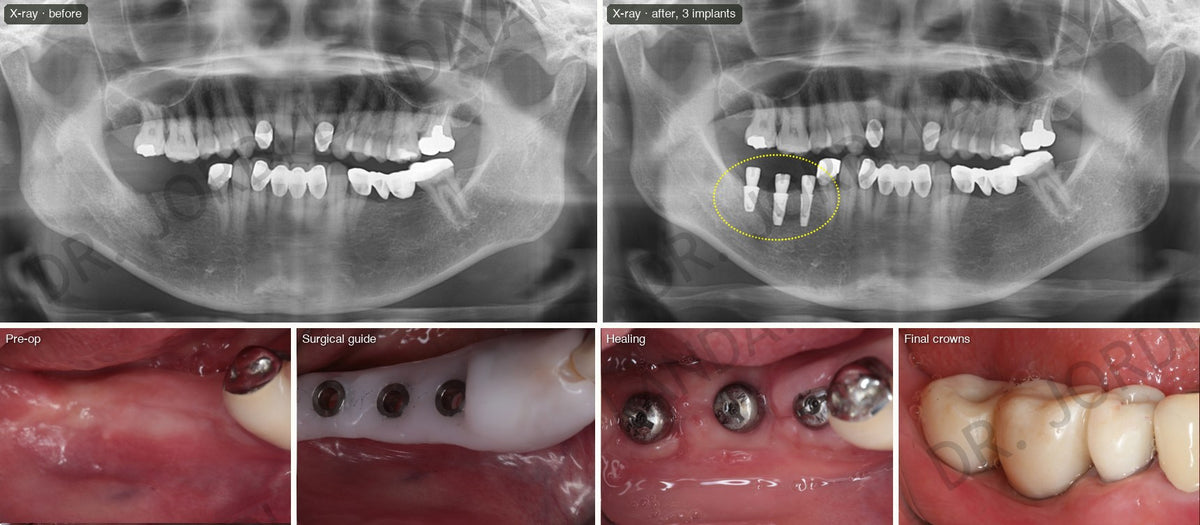 Three implants replacing lower back teeth: X-rays before and after, pre-op, surgical guide, healing and final crowns