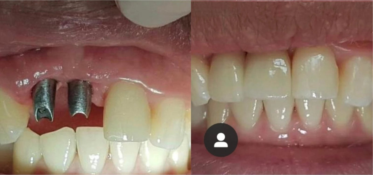 Before and after: two implants replacing missing upper front teeth, finished with custom crowns